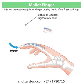 Depicts rupture of extensor digitorum tendon