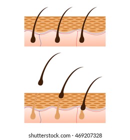 Depilation and skin with hair sectional view - schematic representation isolated on white background. Vector illustration.