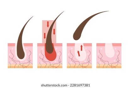 Depilation, a step-by-step method of hair removal. Skin with cut hair - hair removal scheme isolated on white background. Hair loss.