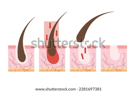Depilation, a step-by-step method of hair removal. Skin with cut hair - hair removal scheme isolated on white background. Hair loss.