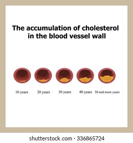 Deposition of cholesterol in function of age. Infographics. Vector illustration.