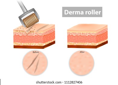 Derma roller or Meso-roller. Skin before and after application Roller for mesotherapy. Vector illustration