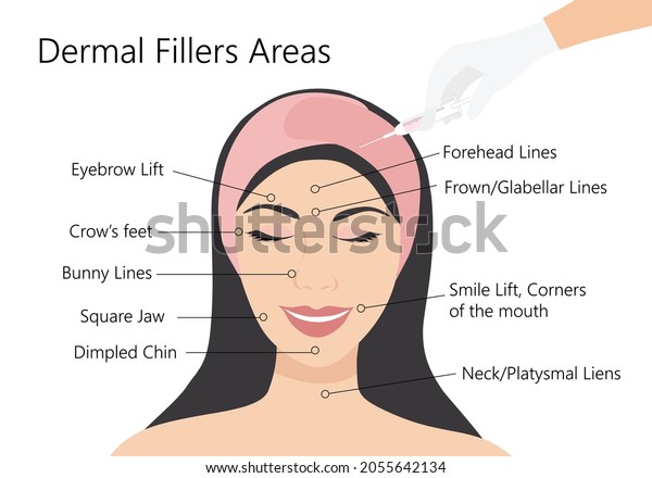 Dermal Filler Botox Injections Areas Woman Stock Vector (Royalty Free ...