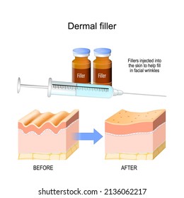 Llenador dérmico. Los colectores se inyectaron en la piel para ayudar a llenar las arrugas faciales. Sección transversal de la piel antes y después de la inyección. iconos de los viales de la jeringa y la vacuna. afiche vectorial