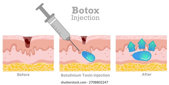 Rellenos dérmicos, inyección de botox, toxina botulínica. Cara, sueros corporales, cuidado de la piel, células muertas viejas. Antes, después. Ilustración vectorial