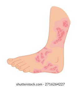 Dermantitis Illustration Element. Illustration of a hand affected by allergies. Flat design illustration of a sick hand. Illustration of a hand with red bumps due to allergie