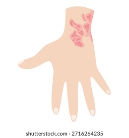 Dermantitis Illustration Element. Illustration of a hand affected by allergies. Flat design illustration of a sick hand. Illustration of a hand with red bumps due to allergie