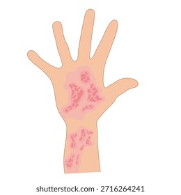 Dermantitis Illustration Element. Illustration einer Hand, die von Allergien betroffen ist. Flaches Design einer kranken Hand. Illustration einer Hand mit roten Beulen aufgrund von Allergie