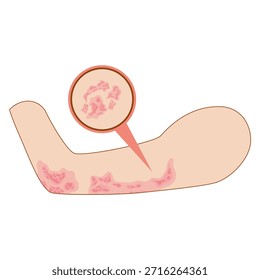 Dermantitis Illustration Element. Illustration of a hand affected by allergies. Flat design illustration of a sick hand. Illustration of a hand with red bumps due to allergie