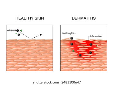 Dermatitis. Eczema. Psoriasis. Cross section of a human skin. Close-up of Inflammation epidermis. Allergens penetration into skin. Atopic dermatitis. Vector illustration