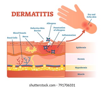 Dermatitis Flat Vector Illustration Diagram Skin Stock Vector (Royalty ...