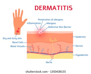 Dermatitis graphic diagram flat style, vector illustration isolated on white background. Educational medical scheme of eczema disease symptoms, skin layers and allergen movement