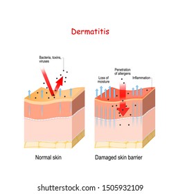 Dermatitis. Normal And Skin With Damaged Barrier. Protection Effect. The Difference Between Healthy And Dry Skin 