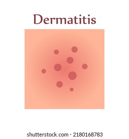 Dermatitis on human skin. Dermatological disease. The symptom is itching, pain, redness and rash. Allergic reaction. Medical diagnostics and treatment. Vector illustration