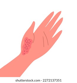 Dermatitis en la piel de una mano humana. Enfermedad dermatológica. El síntoma es picor, dolor, enrojecimiento y erupción cutánea. Reacción alérgica. Diagnóstico médico y tratamiento. Ilustración del vector