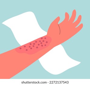 Dermatitis on the skin of a human hand. Dermatological disease. The symptom is itching, pain, redness and rash. Allergic reaction. Medical diagnostics and treatment. Vector illustration