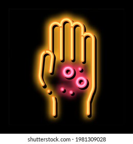 dermatitis erupción en manos del vector de signos de neón. Icono brillante brillante dermatitis erupción en la señal de las manos. ilustración de símbolo transparente