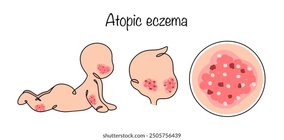 A dermatological disease in which the top layer of skin becomes inflamed, causing redness, rashes and peeling. The disease occurs mainly in children. Color vector illustration.