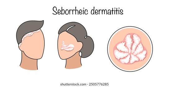 Dermatological inflammatory disease, which is accompanied by the formation of scales on the skin. man and woman with manifestations of dermatitis. Vector illustration.