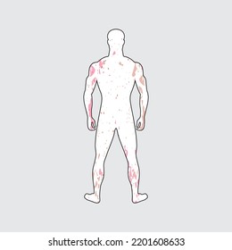 Dermatological patient. Disease manifestation signs. Symptoms of meningitis patient. Painful rash on body with white skin tone. Spots all over body. Allergies, eczema, psoriasis or dermatitis.