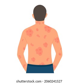 Dermatological skin disease, psoriasis.Allergic itching, skin inflammation, redness and irritation.Guttate psoriasis.Skin problems.isolated, vector.