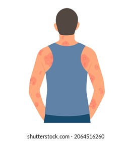 Dermatological skin disease, psoriasis.Allergic itching, skin inflammation, redness and irritation.Guttate psoriasis.Skin problems.isolated, vector.