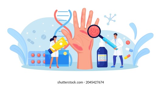 Dermatologist Exam Big Hand with Red Skin and Ras. Psoriasis, Vitiligo, Dermatitis. Eczema - Inflammation Skin Disease. Consequences of Improper Care, Frequent Hand Washing, Disinfection