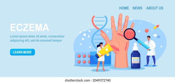 Dermatologist Exam Big Hand with Red Skin and Ras. Psoriasis, Vitiligo, Dermatitis. Eczema - Inflammation Skin Disease. Consequences of Improper Care, Frequent Hand Washing, Disinfection