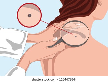 Dermatologist Examining Mole With Magnifying Glass In Clinic (skin Cancer)