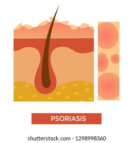 Psoriasis dermatológica enfermedad o enfermedad estructura vectorial de la piel e infección del pelo corporal y descamación enfermedad de la piel y síntomas de tratamiento y enrojecimiento o manchas rojas medicina o problema médico.