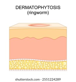 Dermatofitose, infecção fúngica da pele. Seção transversal de uma pele humana com o verme anelar. Fungos queratinofílicos. Micose cutânea. Ilustração vetorial