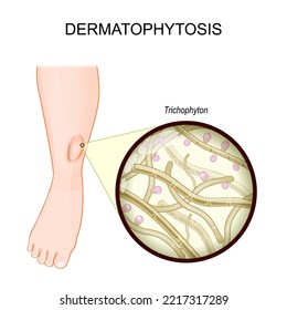 Dermatophytosis. Ringworm on a human leg. fungal infection of the skin. Close-up of a Trichophyton. fungi that caused Ringworm disease. vector illustration