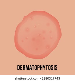 Dermatophytosis skin with fungal infection medical infographic scheme vector flat illustration. Dermatology disorder epidermis pain red circle dry derma illness sickness round itch scratch condition