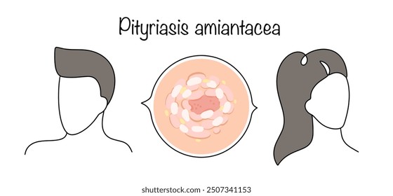 A dermatosis characterized by the formation of dense, thick areas of scaling that are silvery or yellow in color. Color vector illustration on a medical theme.