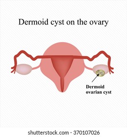 Dermoid cyst on the ovary. Ovary. Infographics. Vector illustration.