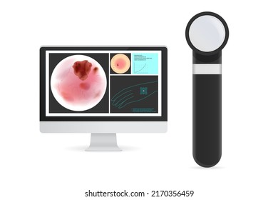 Dermoscopy and monitor with close up skin and chart on the screen for diagnosing of skin cancer disease, tumor. Illustration about binocular microscope of medical.