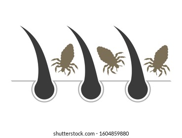 Design of louses in hair illustration