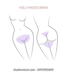 Ausgewiesene Bereiche Haarentfernung Hollywood Bikini, Grenzen für Haarentfernung. Weibliche Enthaarung mit Wachs, Laserepilation.