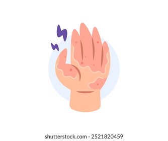 descamación. ilustración de una mano con piel descamada y seca. piel descamada, irritada, con picazón y adolorida. alergia. problemas de salud y enfermedades de la piel. diseño de estilo plano. Elementos