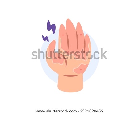 desquamation. illustration of a hand with peeling and dry skin. peeling, irritated, itchy and sore skin. allergy. health problems and skin diseases. flat style design. elements
