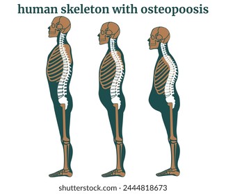 Destrucción de la columna vertebral humana por osteoporosis. Estatura reducida, deformación del cuerpo. Cambios en la postura relacionados con la Edad. Afiche médico, Ilustración vectorial