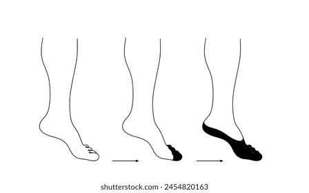 Destruction of nerve fibers and endings in a person’s leg, leading to gangrene. A consequence of severe diabetes mellitus. Vector illustration on a medical theme.