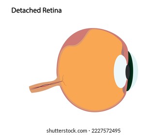 Detached retina illustration. Eye with detached retina 