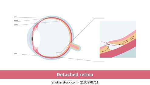 Detached retina (retinal detachment). The thin layer at the back of the eye (retina) becomes loose.  Retina lifts away from the back of the eye and does not work, making vision blurry.