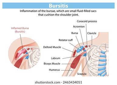 Detailed anatomy of shoulder bursitis inflammation