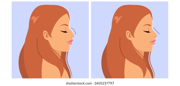 Detailed cartoon illustration showing woman nose profile before and after rhinoplasty surgery. Drawing for cosmetic surgery clinics, beauty blogs, health-related content