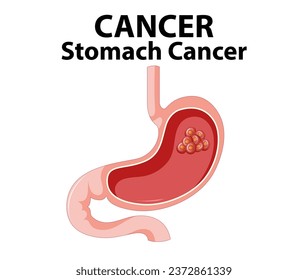 Detailed cartoon-style illustration depicting the anatomy of stomach cancer