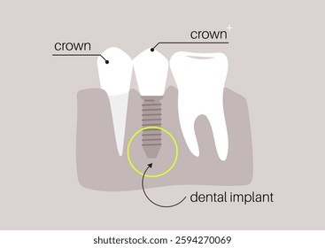 Detailed depiction showcasing the intricate components of a dental implant, highlighting the crown, screw, and adjacent tooth structure for a better understanding of dental restoration processes