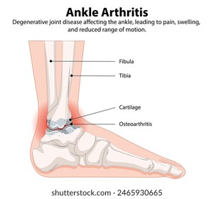 Detailed diagram of ankle arthritis and affected areas