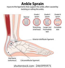 Detailed diagram of ankle sprain types